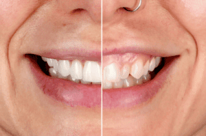 The Porcelain Veneers Process: What to Expect